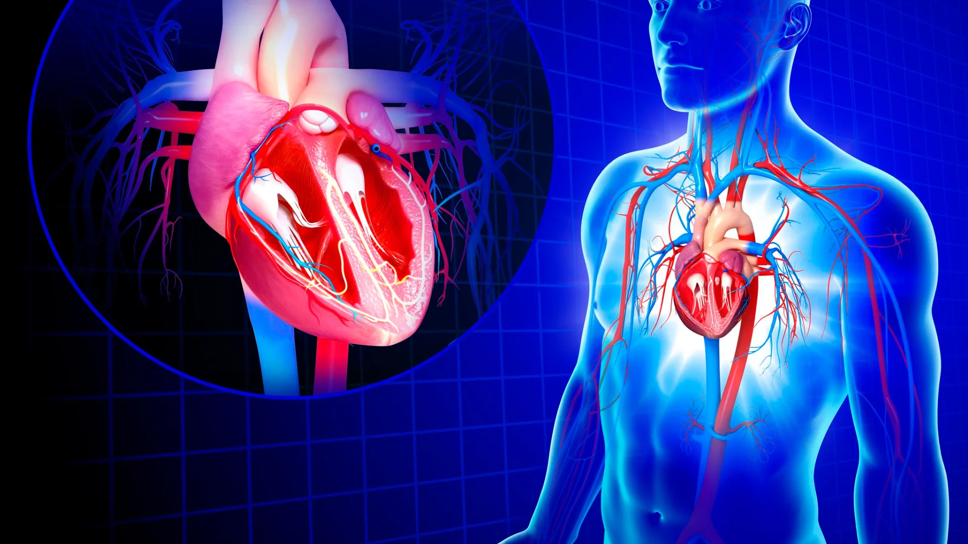 Atherosclerosis in the Carotid Arteries
